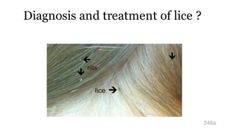 Diagnosis and treatment of lice ?
246a
 