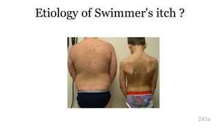 Etiology of Swimmer's itch ?
247a
 