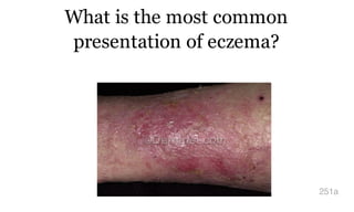 What is the most common
presentation of eczema?
251a
 