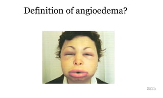 Definition of angioedema?
252a
 