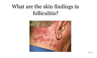 What are the skin findings in
folliculitis?
254a
 