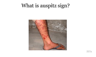 What is auspitz sign?
257a
 