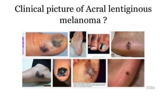 Clinical picture of Acral lentiginous
melanoma ?
258a
 