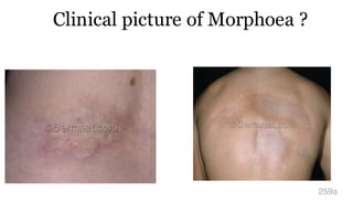 Clinical picture of Morphoea ?
259a
 