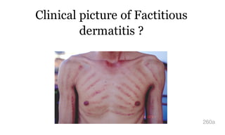 Clinical picture of Factitious
dermatitis ?
260a
 