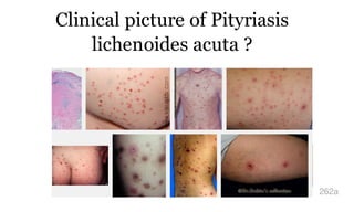 Clinical picture of Pityriasis
lichenoides acuta ?
262a
 