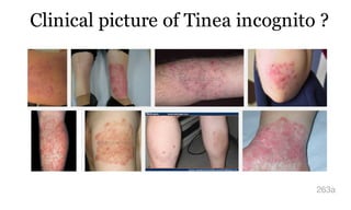 Clinical picture of Tinea incognito ?
263a
 