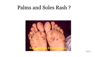 Palms and Soles Rash ?
265a
Keratoderma blenorrhagica
 