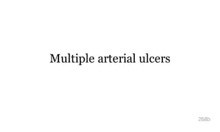 Multiple arterial ulcers
268b
 