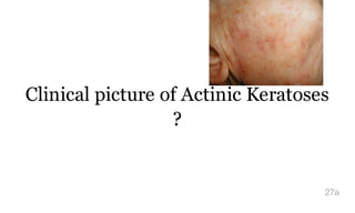 Clinical picture of Actinic Keratoses
?
27a
 