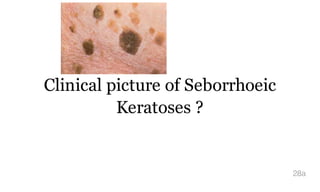 Clinical picture of Seborrhoeic
Keratoses ?
28a
 