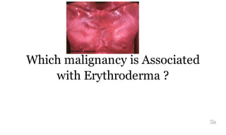 Which malignancy is Associated
with Erythroderma ?
3a
 