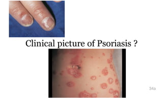 Clinical picture of Psoriasis ?
34a
 