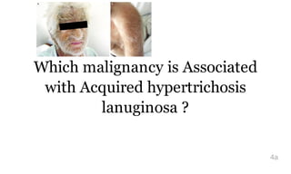 Which malignancy is Associated
with Acquired hypertrichosis
lanuginosa ?
4a
 