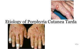 Etiology of Porphyria Cutanea Tarda
?
46a
 