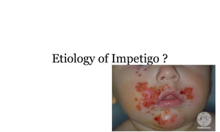 Etiology of Impetigo ?
50a
 