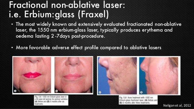 ablative laser