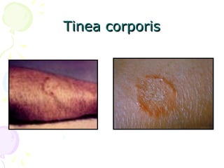 Tinea corporisTinea corporis
 