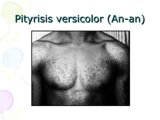 Pityrisis versicolor (An-an)Pityrisis versicolor (An-an)
 