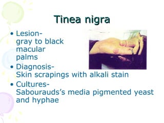 Tinea nigraTinea nigra
• Lesion-
gray to black
macular
palms
• Diagnosis-
Skin scrapings with alkali stain
• Cultures-
Sabourauds’s media pigmented yeast
and hyphae
 