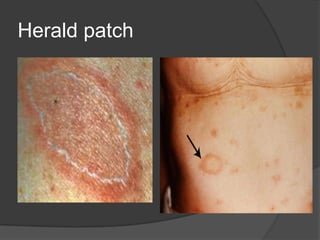 Dermatology osce slides | PPTX
