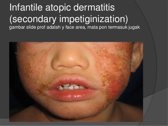 Atopic dermatitis slides