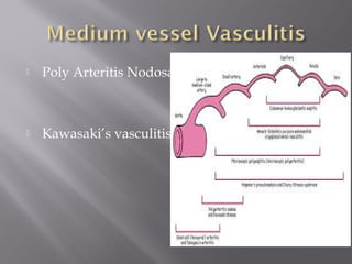  Poly Arteritis Nodosa
 Kawasaki’s vasculitis
 