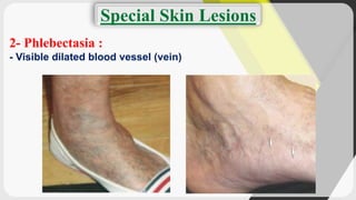 Phlebectatica Dermatology (terminology of skin lesions) | PDF