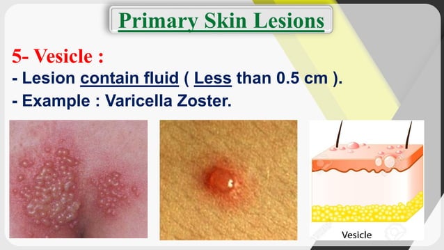 Dermatology (terminology of skin lesions)