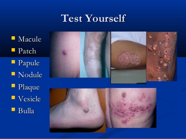Dermatology Macule Papule Patch Dermatology Macule Papule Patch