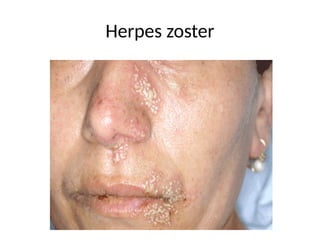 Herpes zoster
 