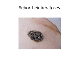 Seborrheic keratoses
 