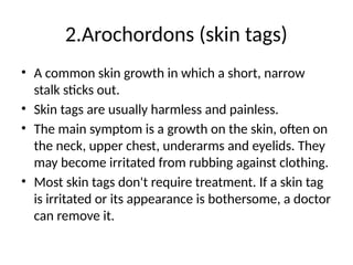2.Arochordons (skin tags)
• A common skin growth in which a short, narrow
stalk sticks out.
• Skin tags are usually harmless and painless.
• The main symptom is a growth on the skin, often on
the neck, upper chest, underarms and eyelids. They
may become irritated from rubbing against clothing.
• Most skin tags don't require treatment. If a skin tag
is irritated or its appearance is bothersome, a doctor
can remove it.
 