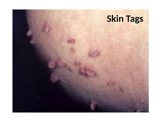 Skin Tags
 
