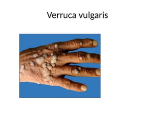 Verruca vulgaris
 