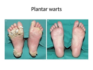 Plantar warts
 