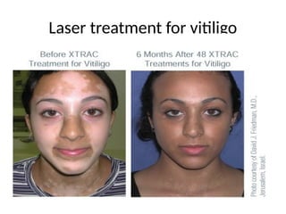 Laser treatment for vitiligo
 