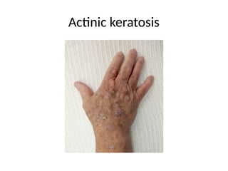 Actinic keratosis
 
