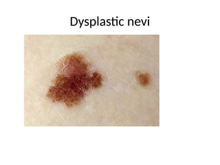 Dysplastic nevi
 