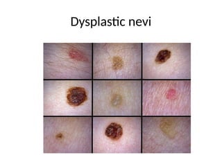 Dysplastic nevi
 