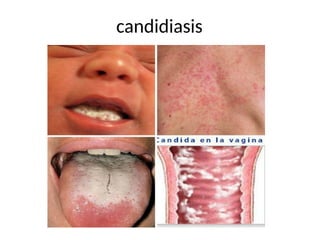 candidiasis
 
