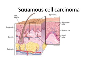 Squamous cell carcinoma
 