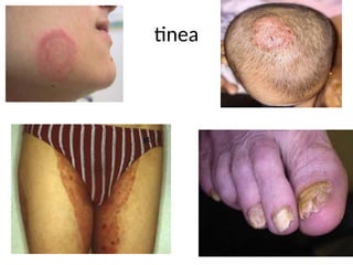 tinea
 