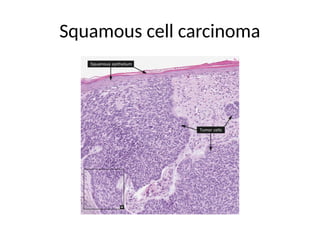 Squamous cell carcinoma
 