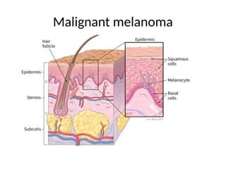 Malignant melanoma
 