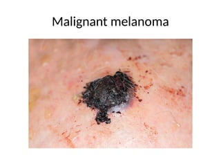 Malignant melanoma
 