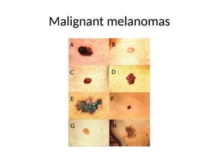 Malignant melanomas
 