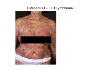 Cutaneous T – CELL Lymphoma
 