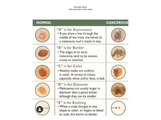 Education about
Self examination of the moles
 