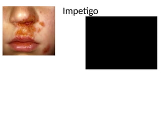 Impetigo
 
